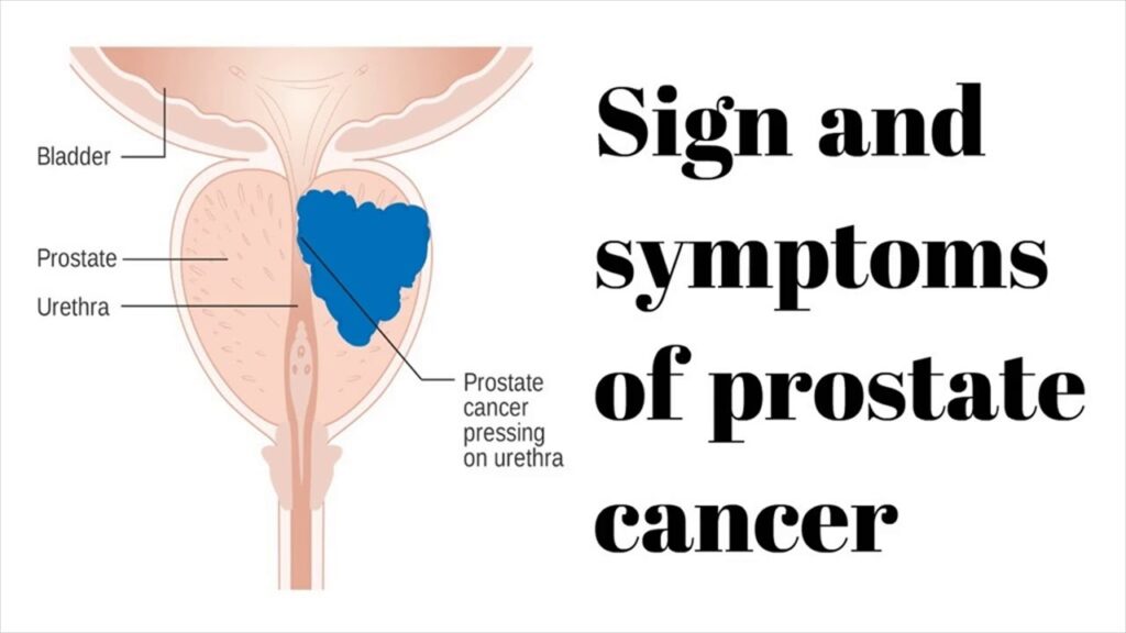 What Are the Signs of Prostate Issues